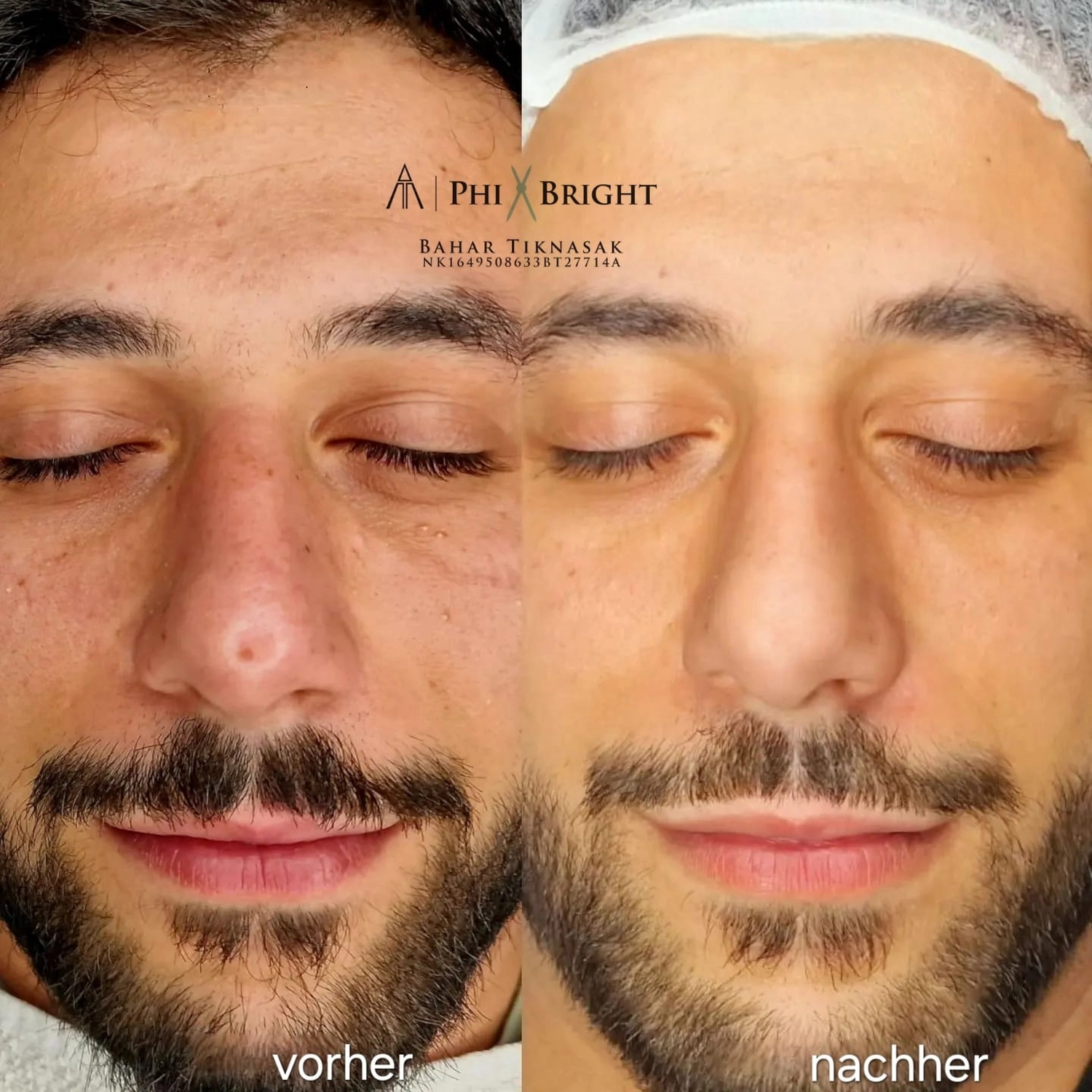 Vorher / Nachher  von Beauty-byBahar